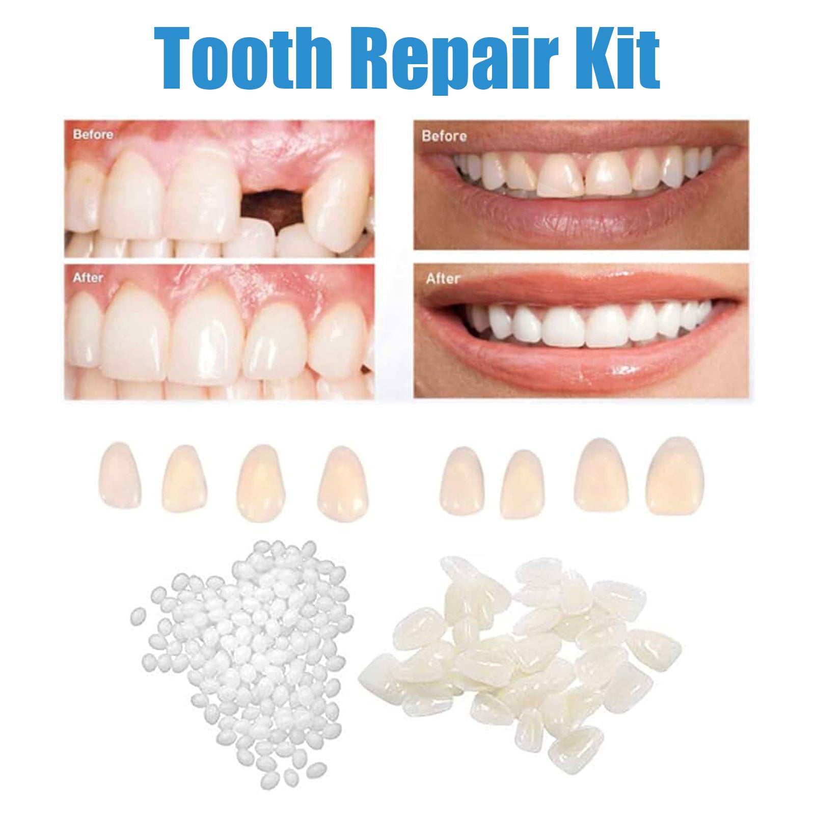 Professional Teeth Repair Kit - Instant Temporary Fix for Missing, Broken-30g