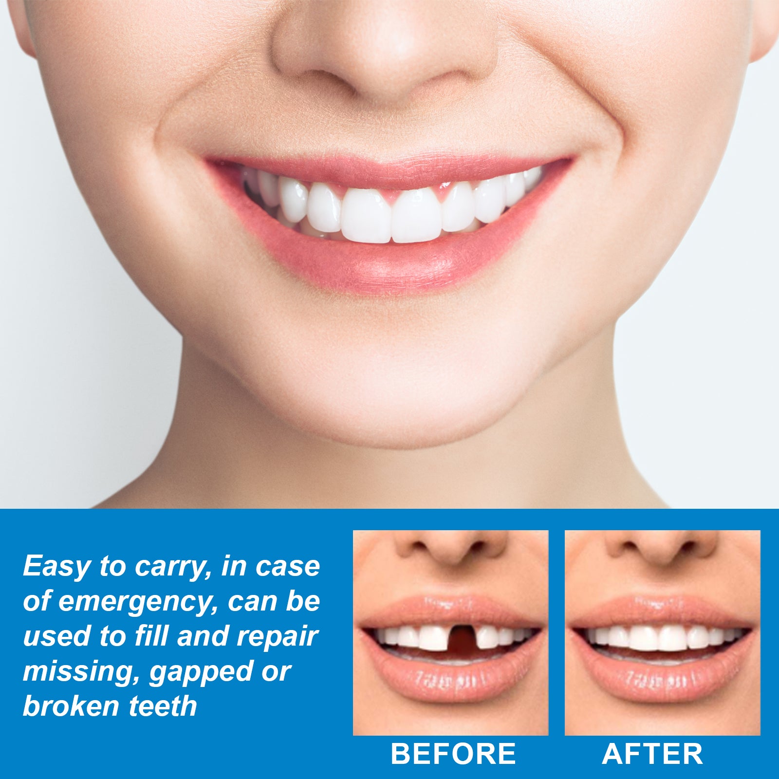 Professional Teeth Repair Kit - Instant Temporary Fix for Missing, Broken-30g