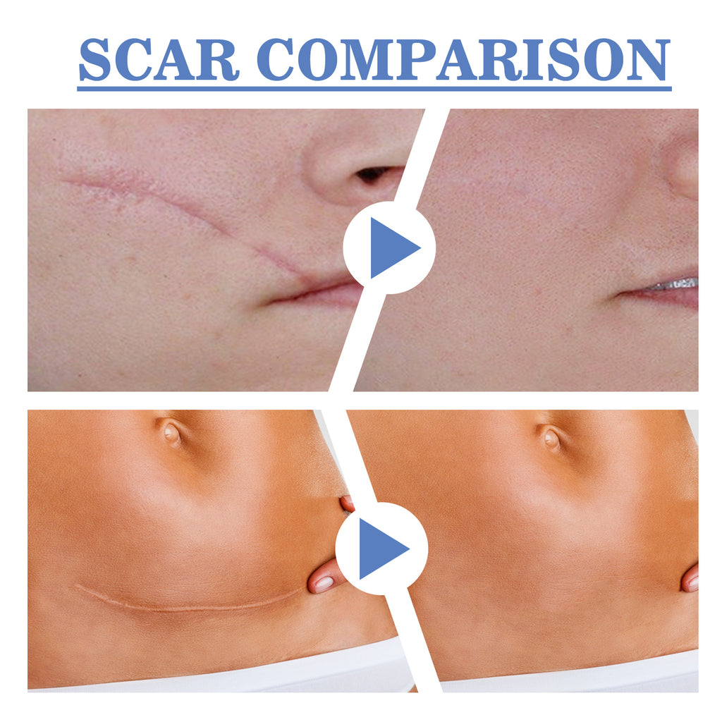 MediPatch Silicone Scar Sheets – Doctor-Tested, Invisible Healing for Surgery, Acne & Burn Scars