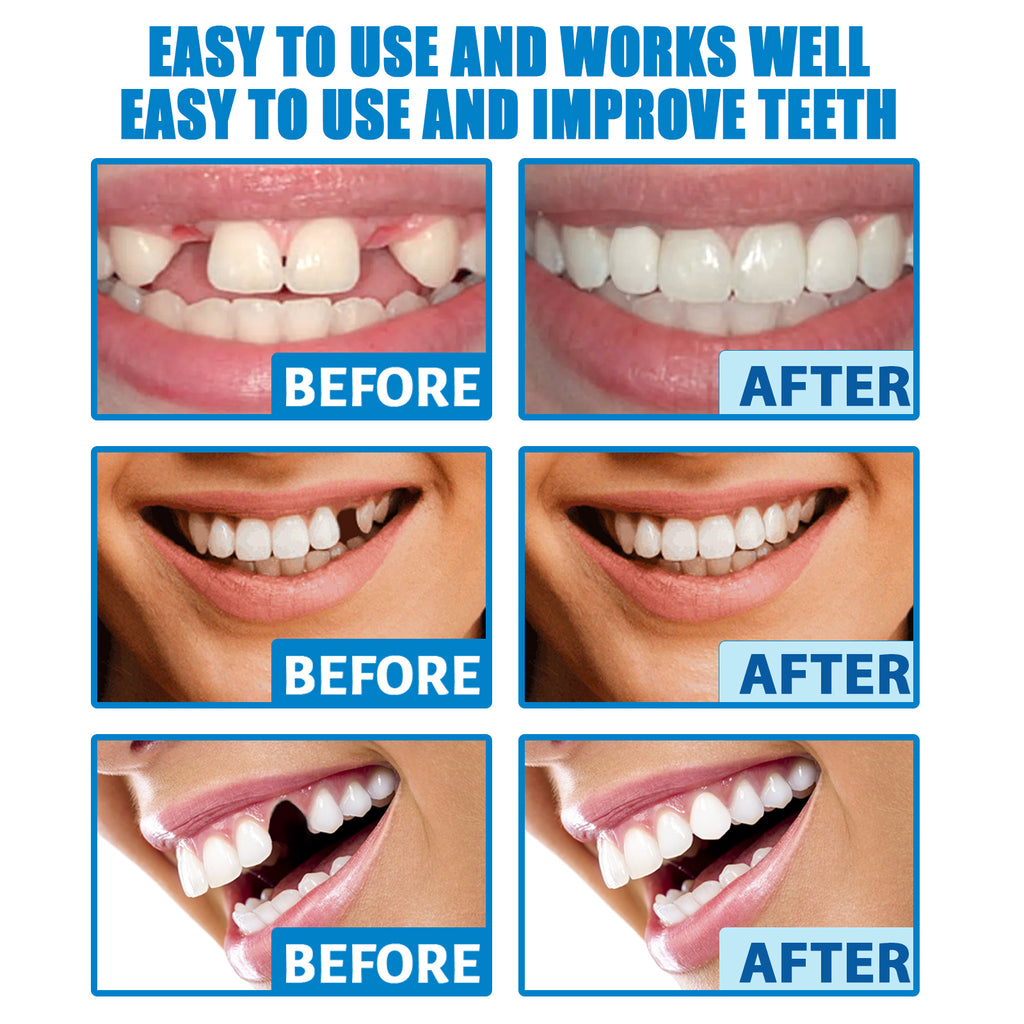 Professional Teeth Repair Kit - Instant Temporary Fix for Missing, Broken-30g